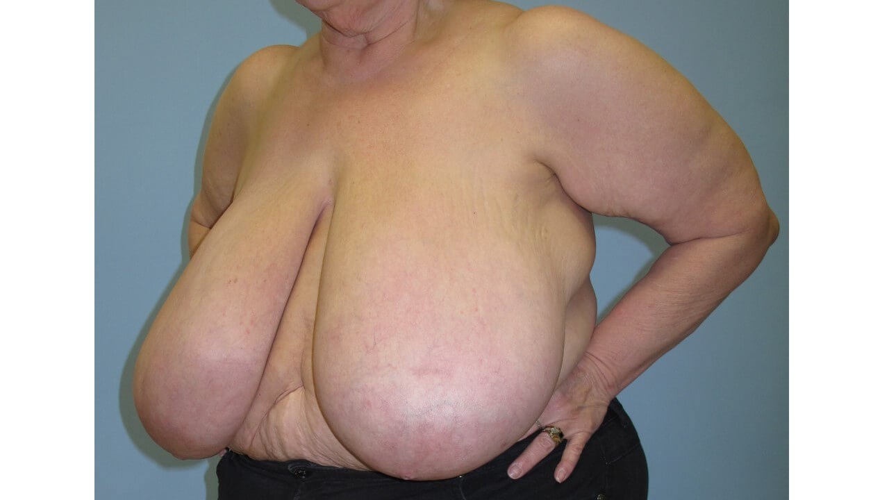 Bilateral Breast Reduction Before