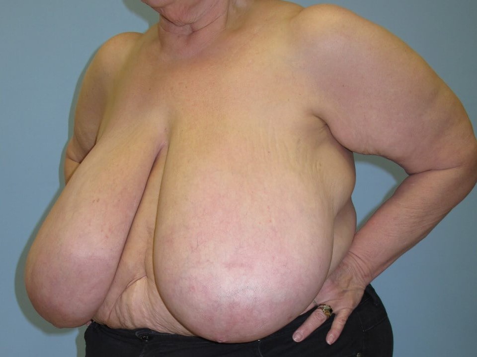Bilateral Breast Reduction Before