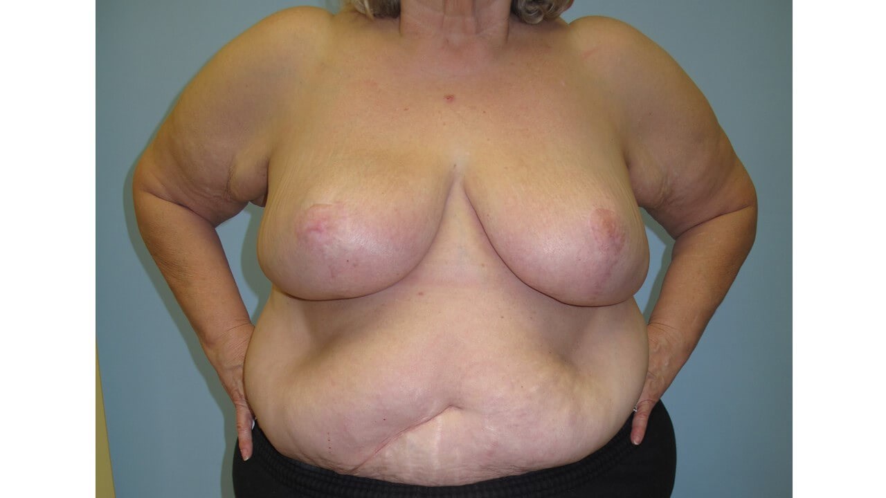 Bilateral Breast Reduction After