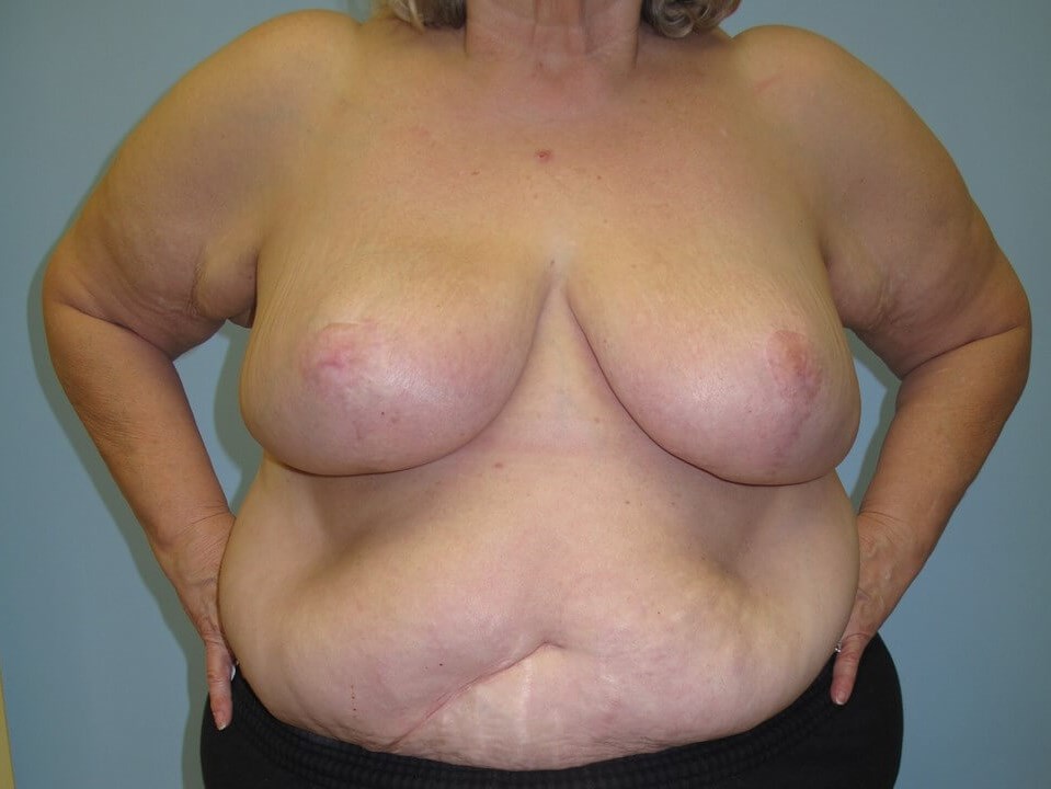 Bilateral Breast Reduction After