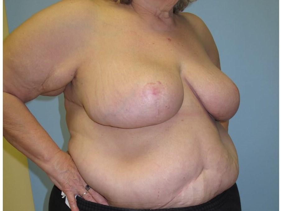 Bilateral Breast Reduction After