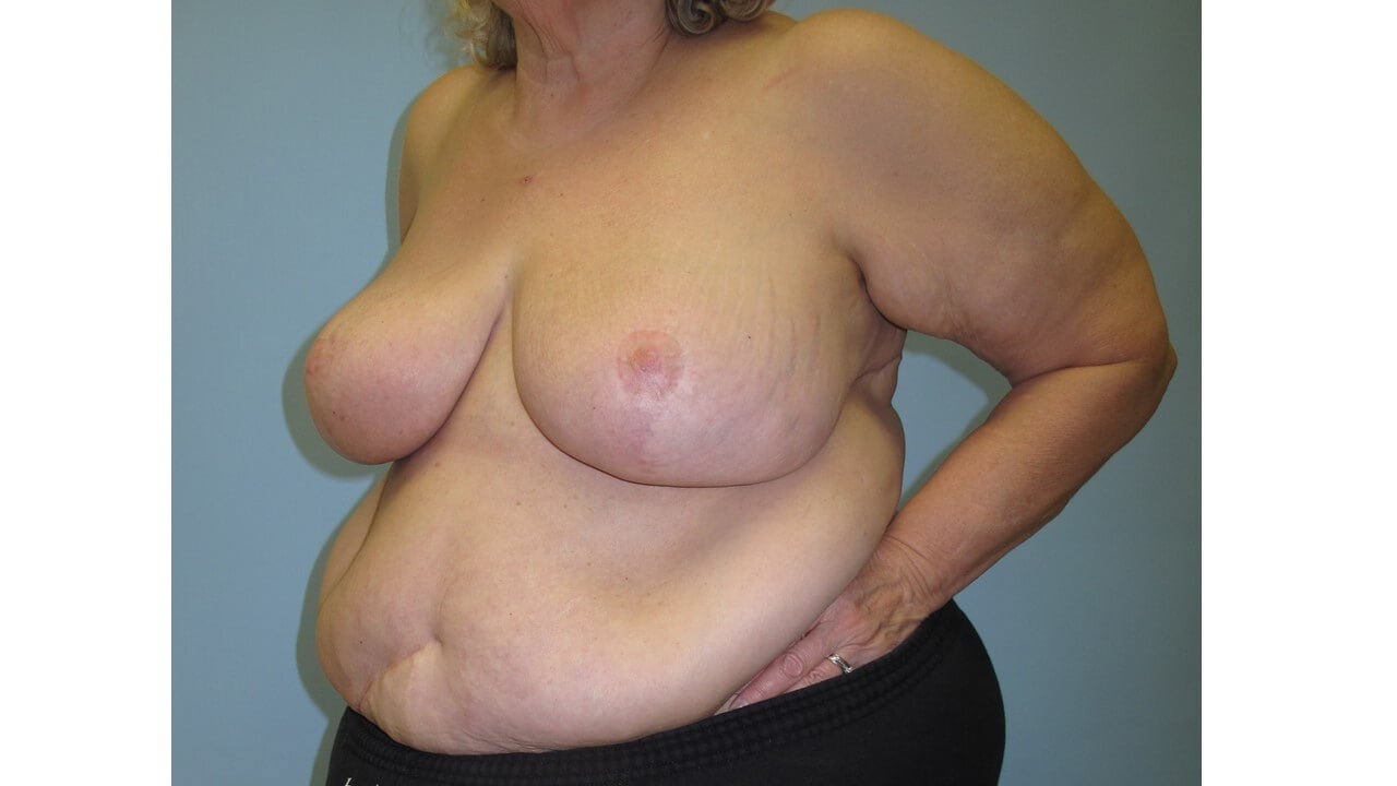 Bilateral Breast Reduction After