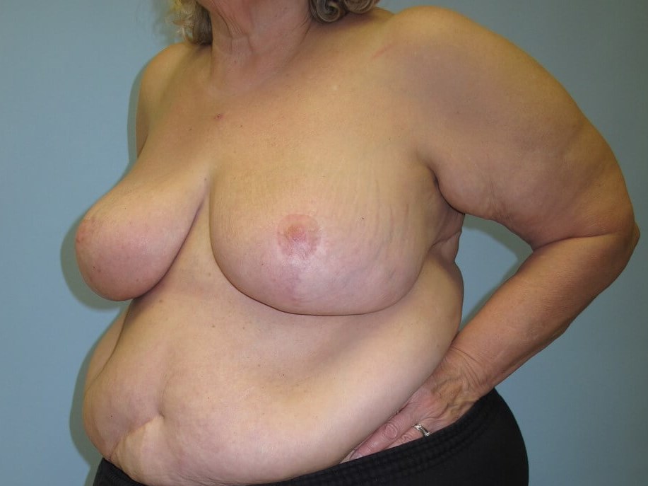 Bilateral Breast Reduction After