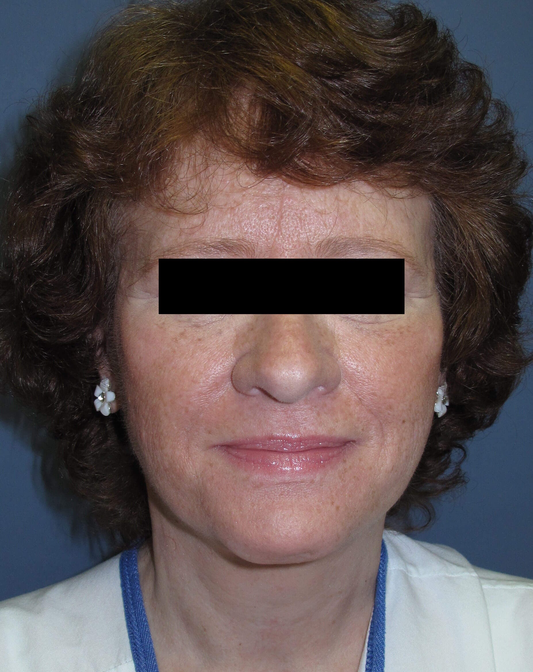 Face lift & Neck lift After (Front)