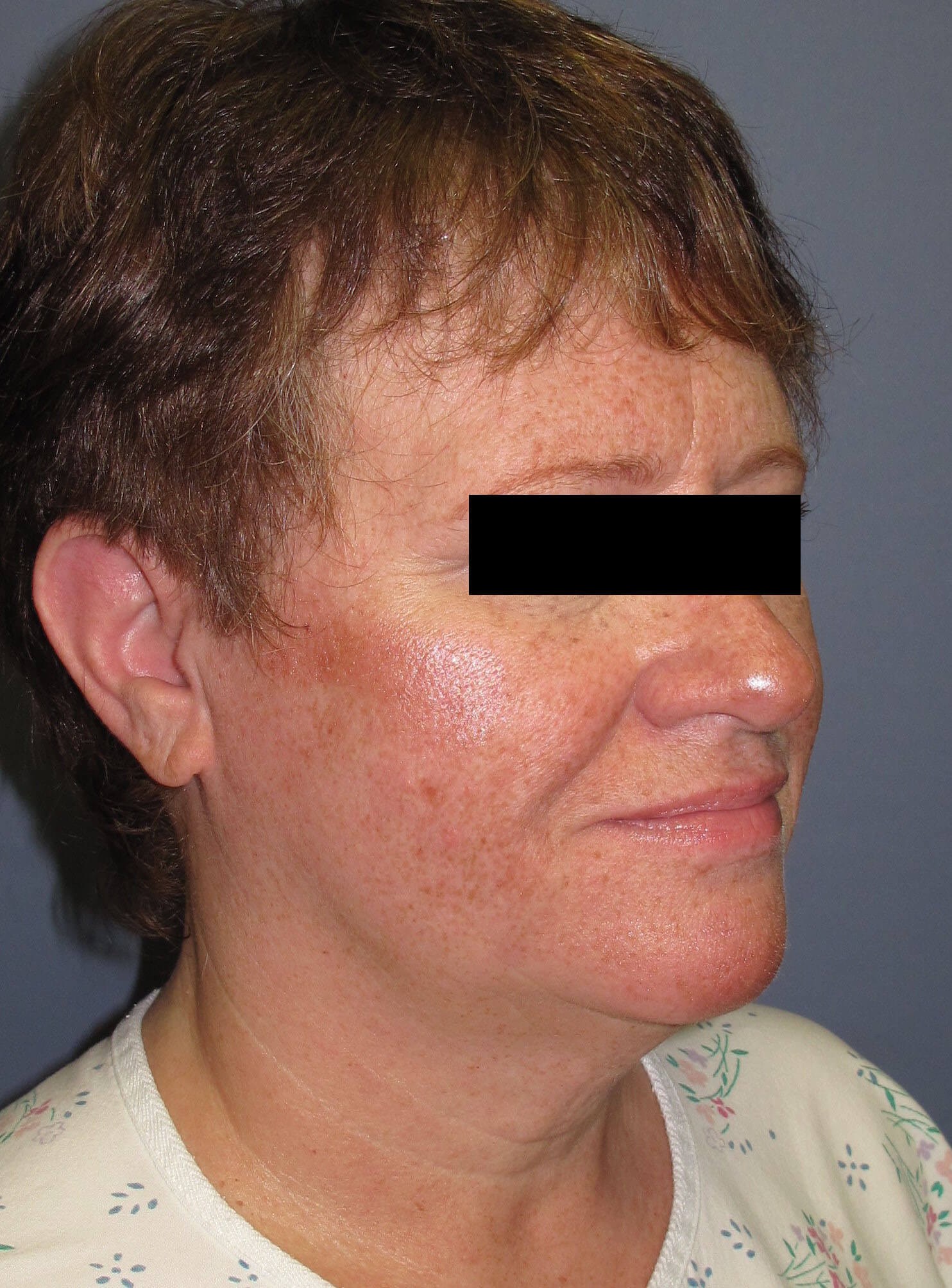 Face lift & Neck lift Before (Oblique View)