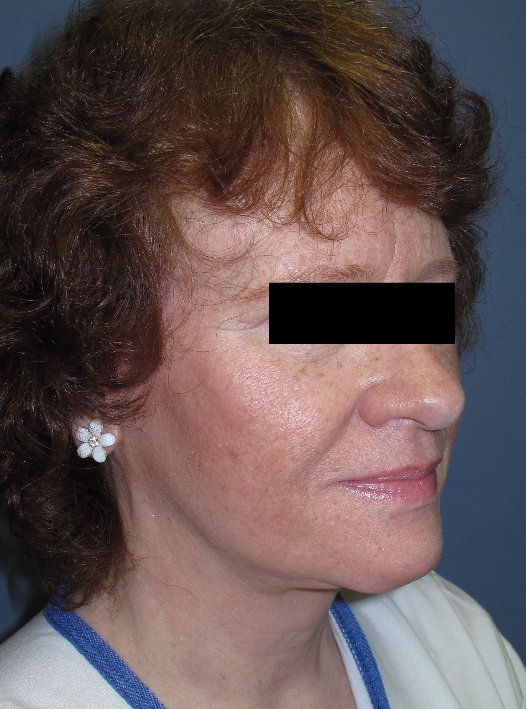 Face lift & Neck lift After (Oblique View)