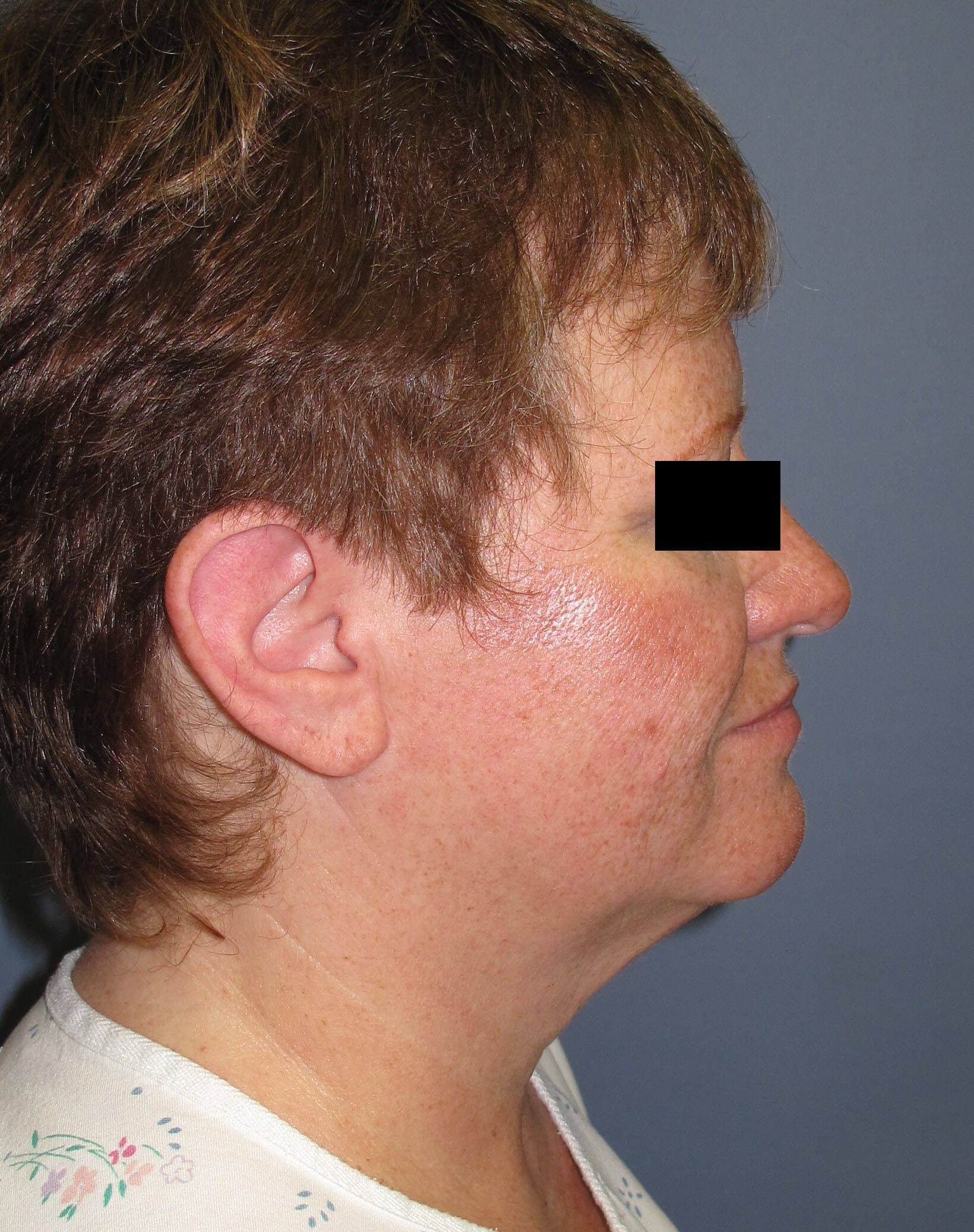 Face lift & Neck lift Before (Side View)