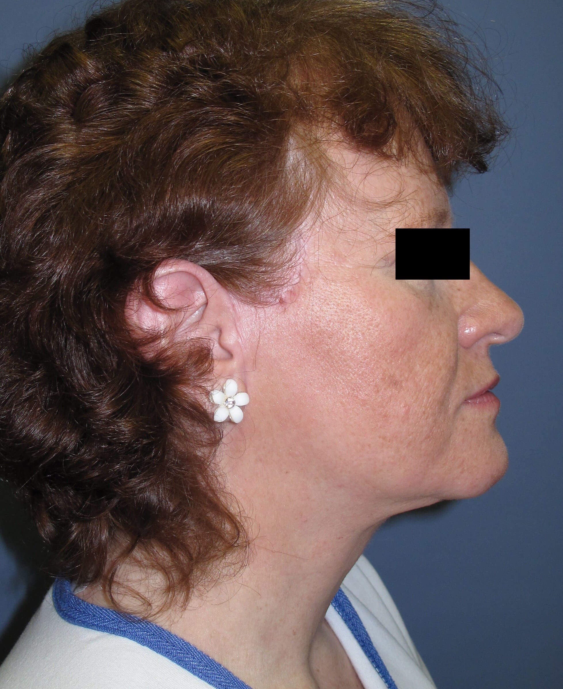 Face lift & Neck lift After (Side View)