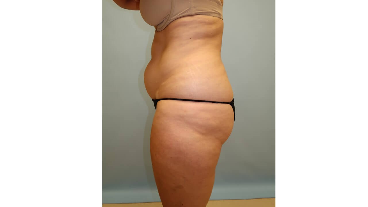 UltraShape Power/VelaShape III Before (Side View)