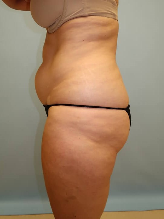 UltraShape Power/VelaShape III Before (Side View)