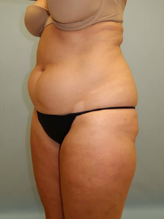 UltraShape Power/VelaShape III Before (Oblique View)