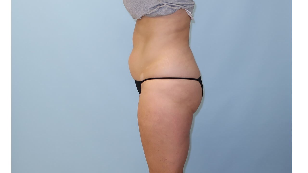 UltraShape Power/VelaShape III After (Side View)