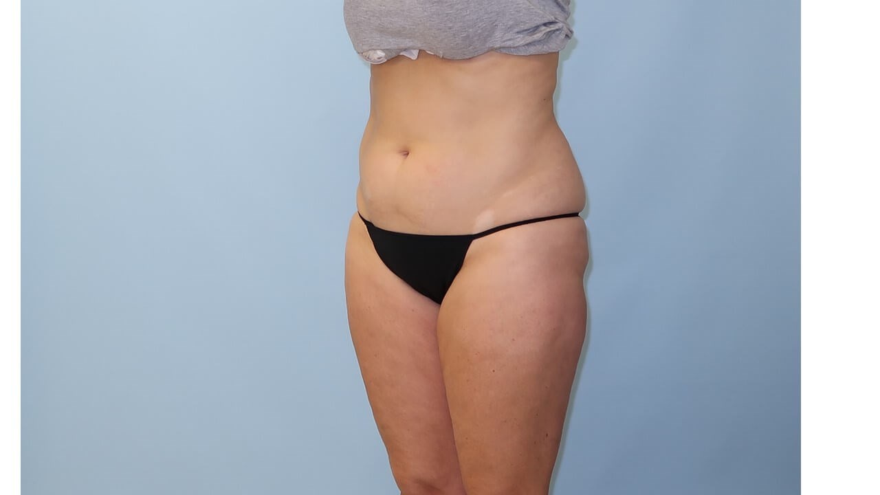 UltraShape Power/VelaShape III After (Oblique View)