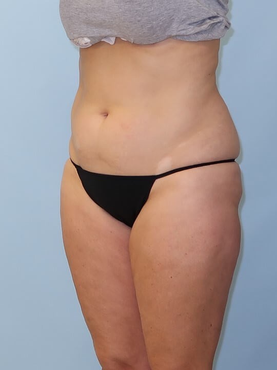 UltraShape Power/VelaShape III After (Oblique View)