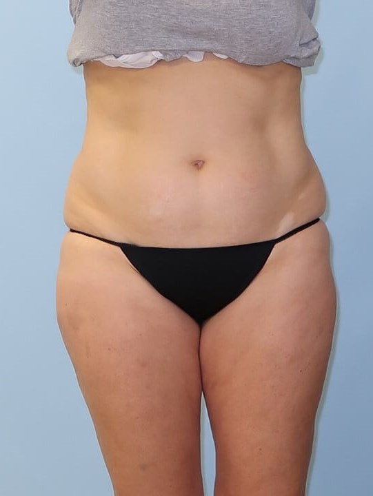 UltraShape Power/VelaShape III After (Frontal view)
