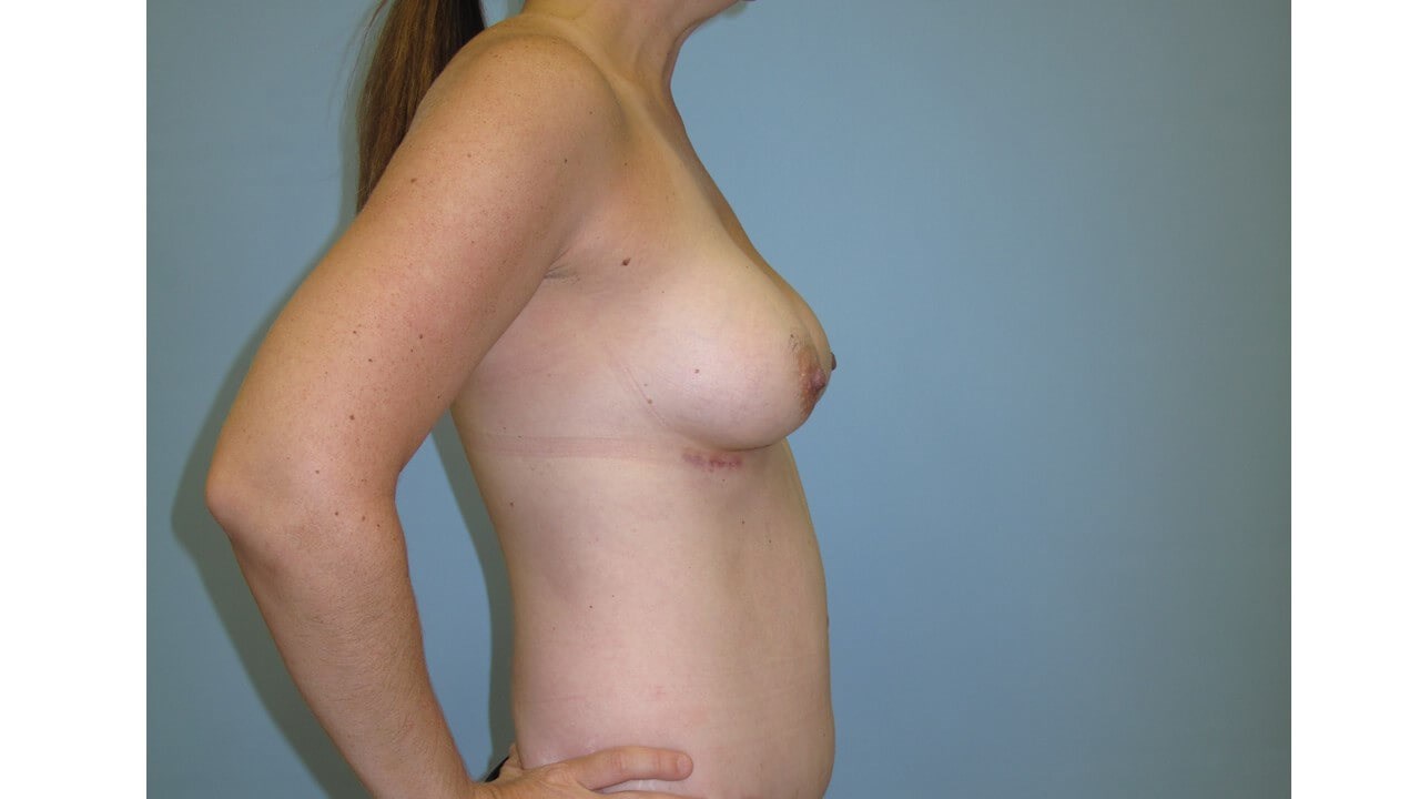 Breast Augmentation After