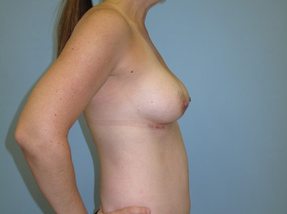 Breast Augmentation After