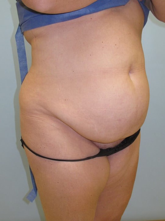 Abdominoplasty (Tummy Tuck) Before