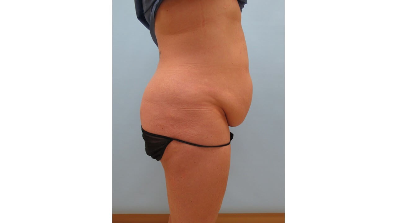 Abdominoplasty (Tummy Tuck) Before