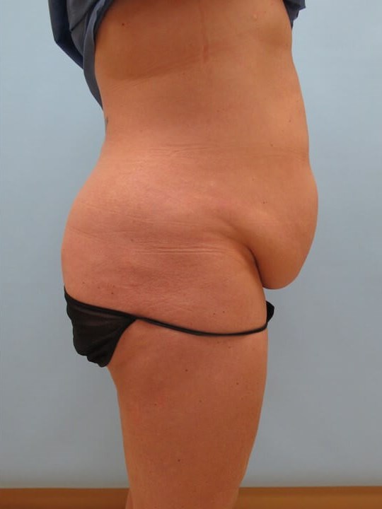 Abdominoplasty (Tummy Tuck) Before