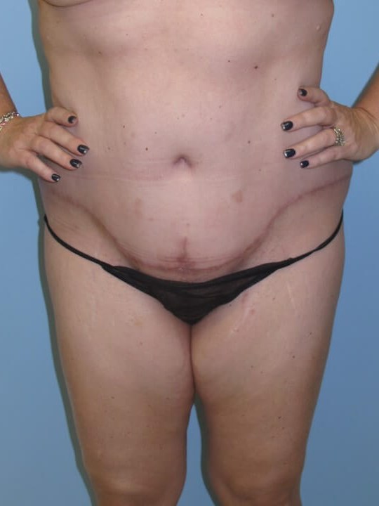 Abdominoplasty (Tummy Tuck) After