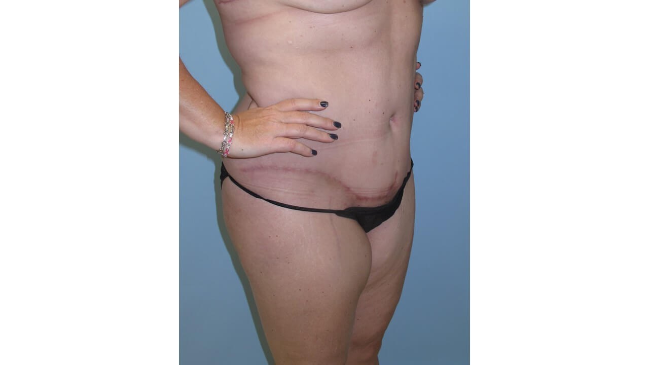 Abdominoplasty (Tummy Tuck) After
