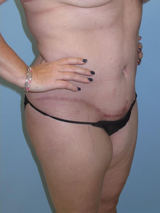 Abdominoplasty (Tummy Tuck) After