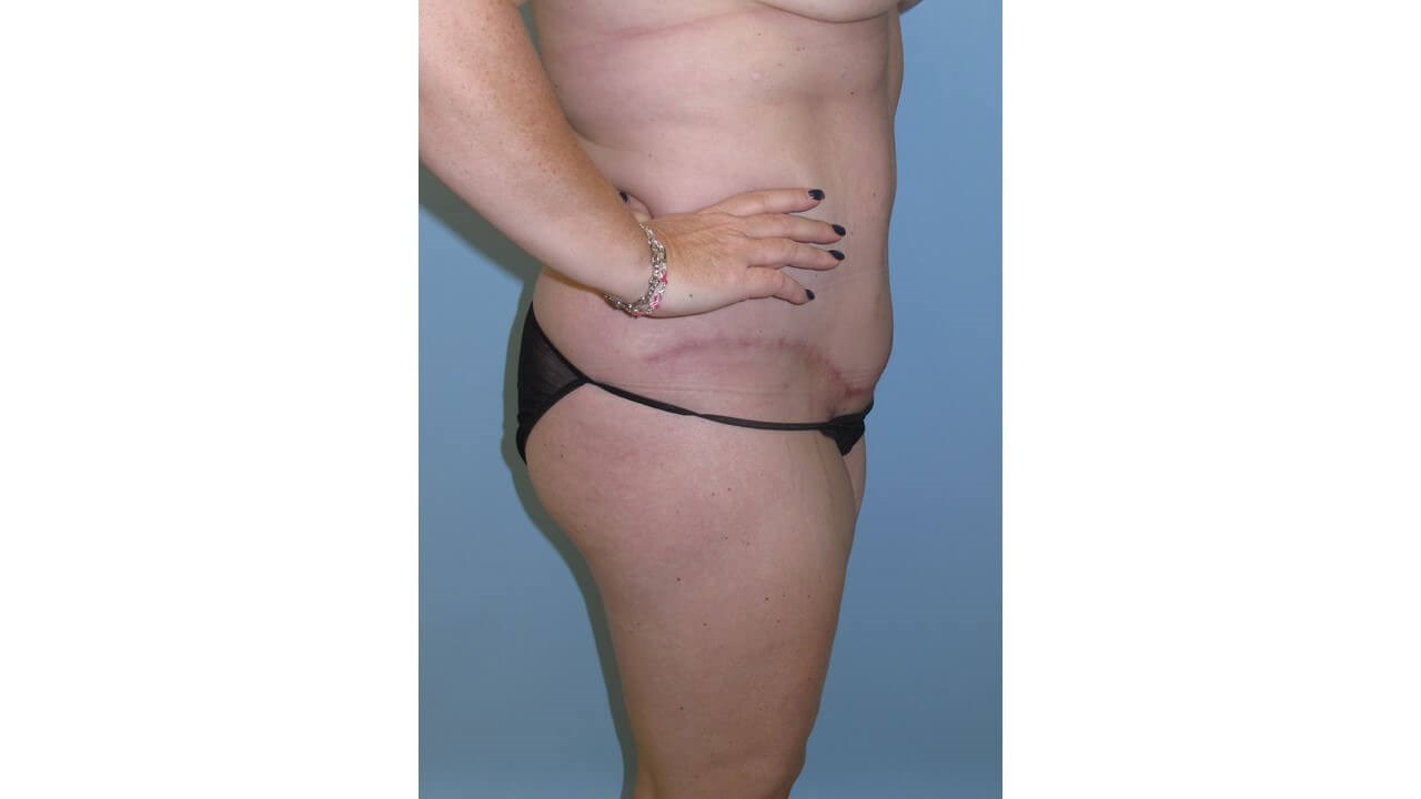 Abdominoplasty (Tummy Tuck) After