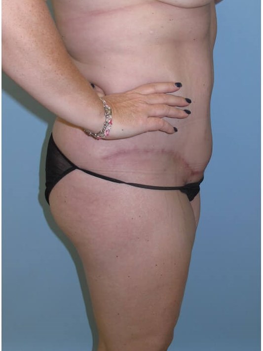 Abdominoplasty (Tummy Tuck) After