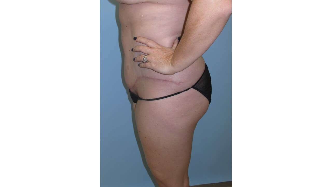 Abdominoplasty (Tummy Tuck) After
