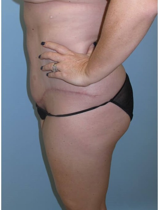 Abdominoplasty (Tummy Tuck) After