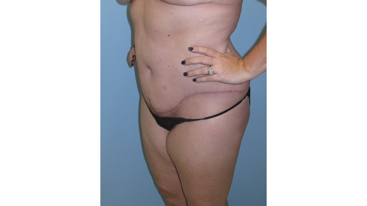 Abdominoplasty (Tummy Tuck) After
