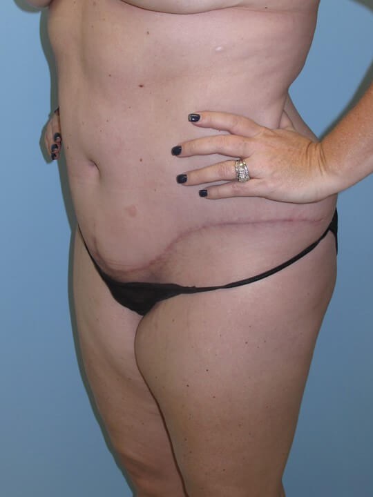 Abdominoplasty (Tummy Tuck) After