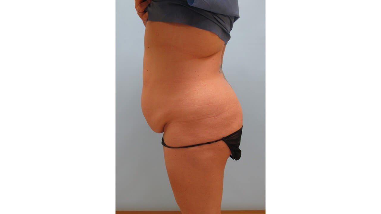 Abdominoplasty (Tummy Tuck) Before