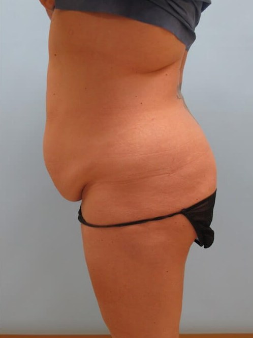 Abdominoplasty (Tummy Tuck) Before