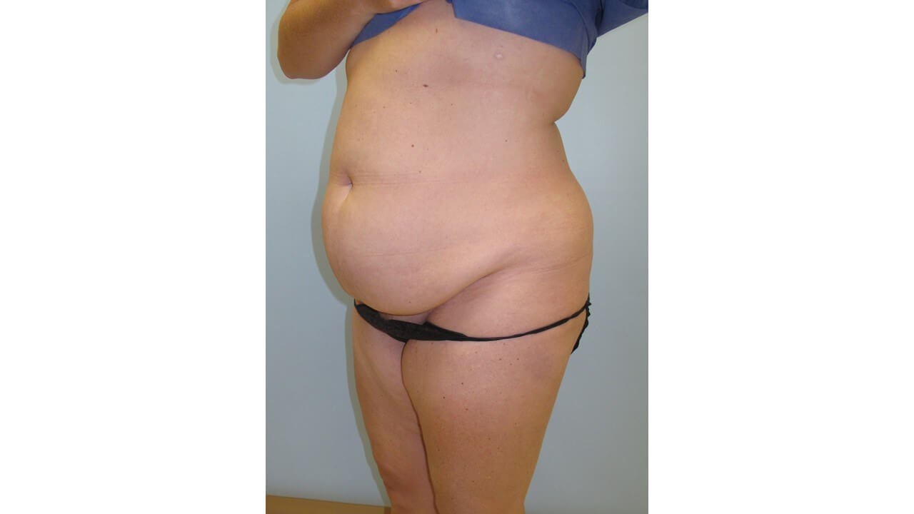 Abdominoplasty (Tummy Tuck) Before