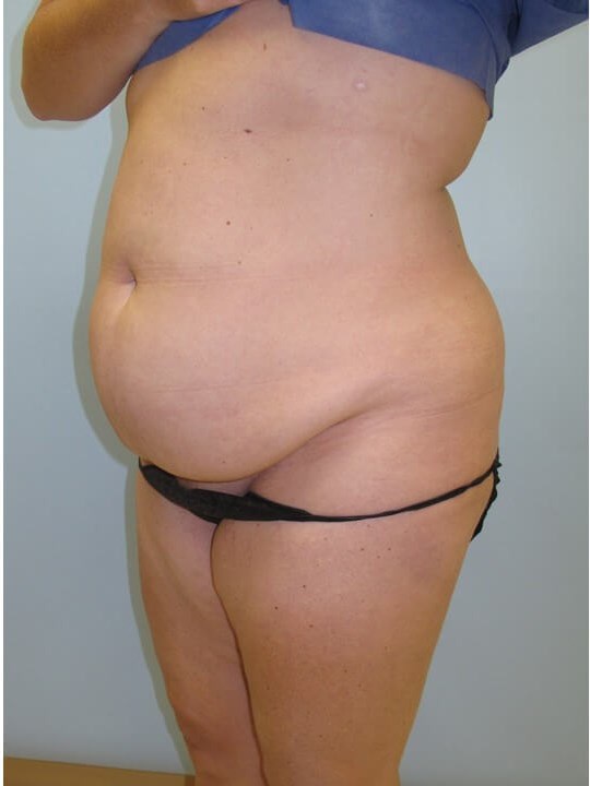 Abdominoplasty (Tummy Tuck) Before