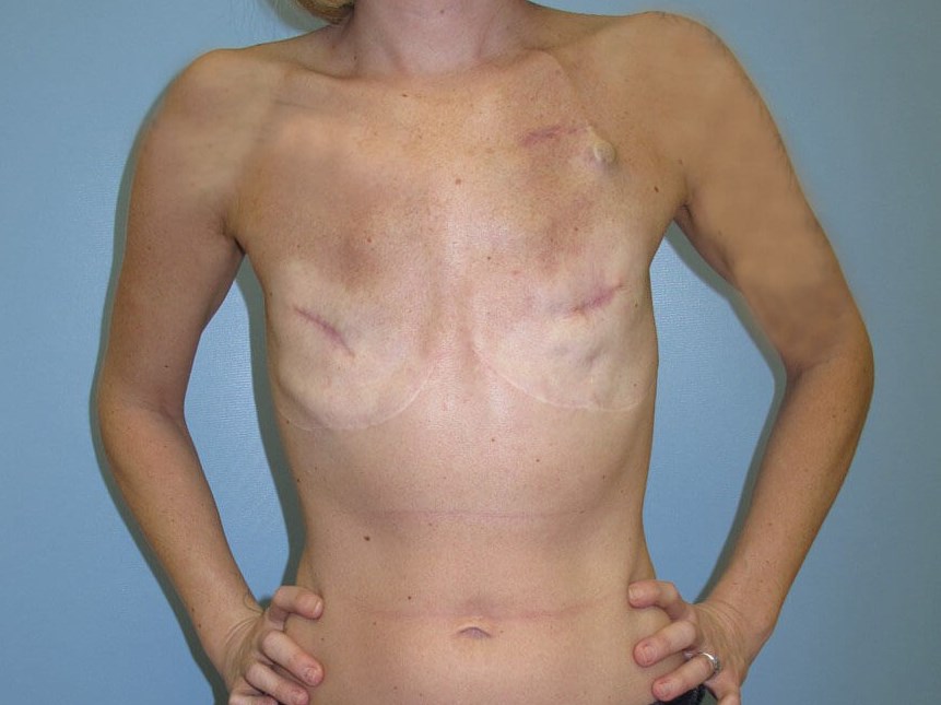 Breast Reconstruction Before