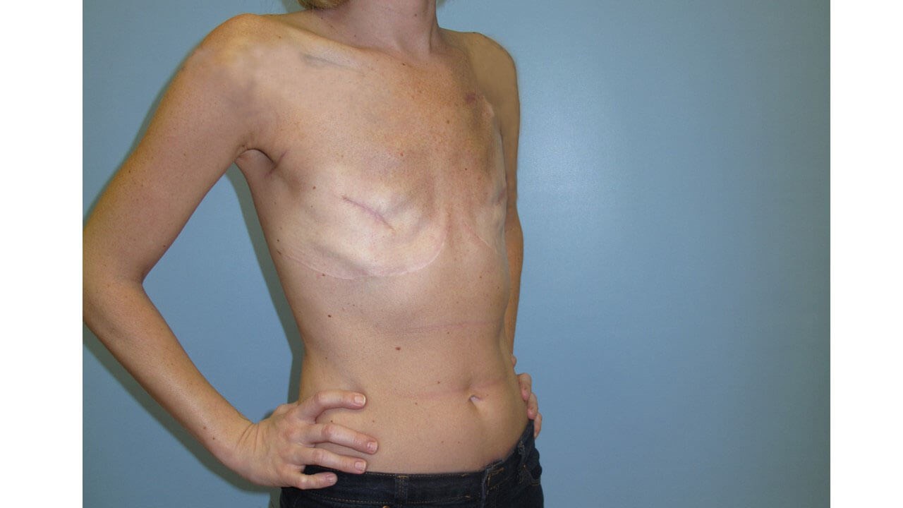 Breast Reconstruction Before