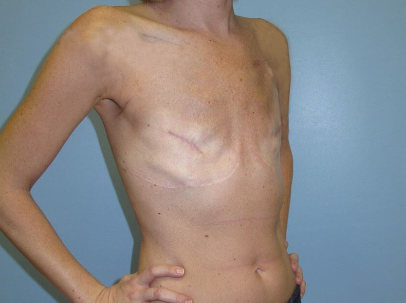 Breast Reconstruction Before