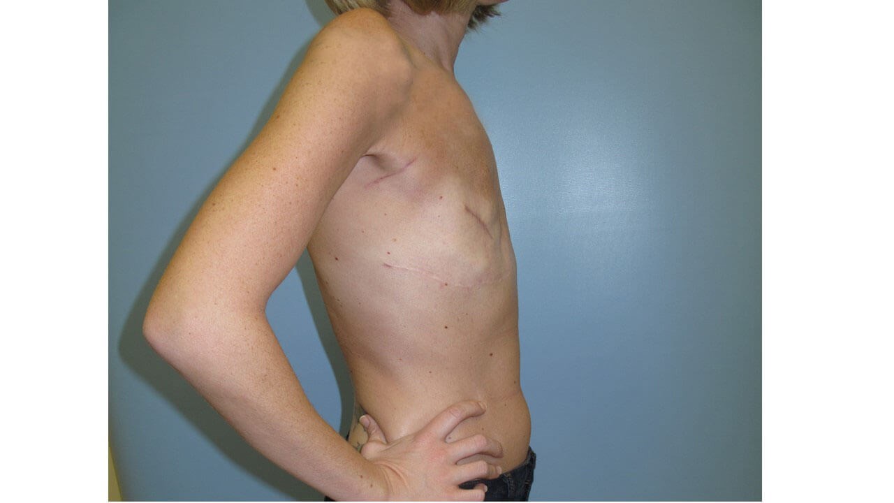Breast Reconstruction Before