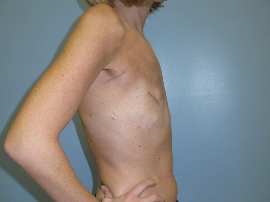 Breast Reconstruction Before