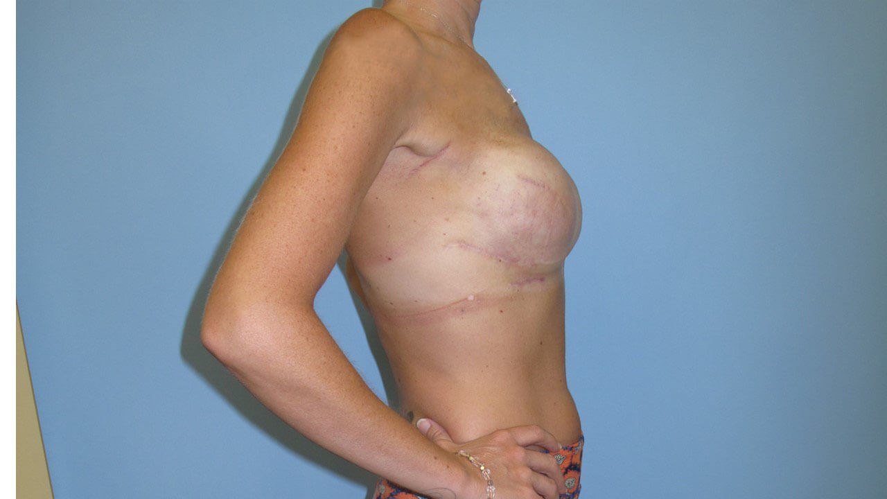 Breast Reconstruction After