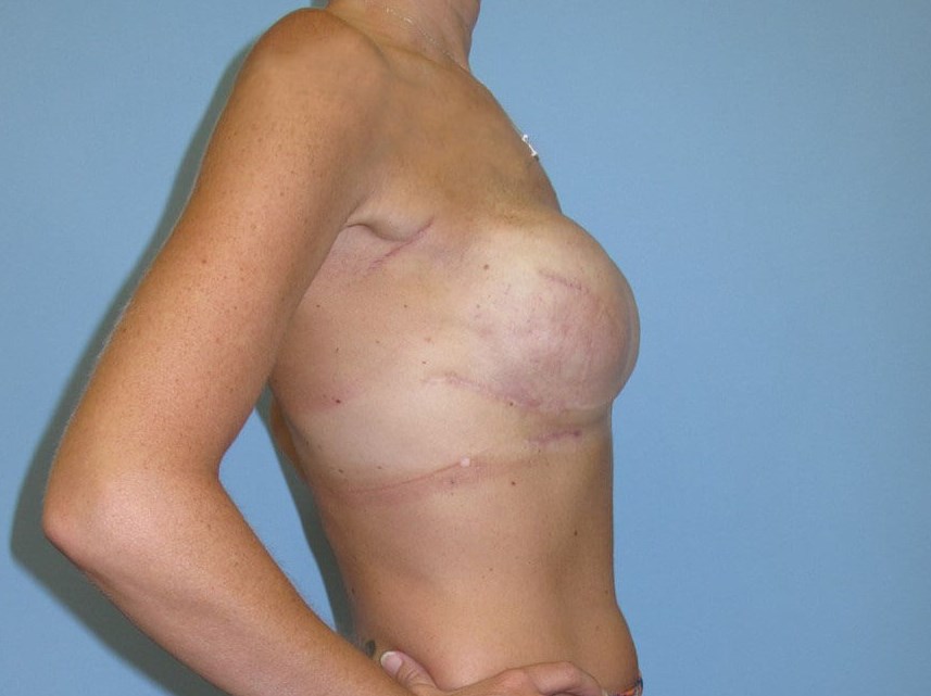 Breast Reconstruction After