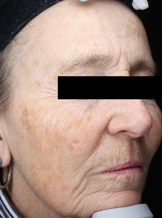 Chemical peel medium depth After (Front)