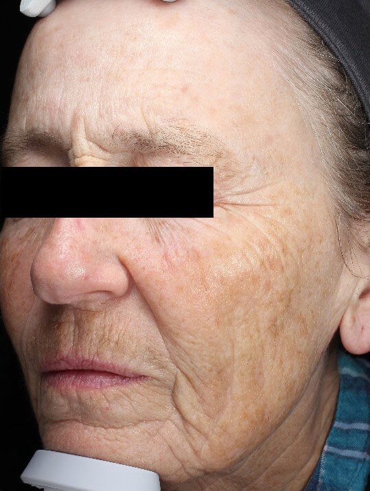 Chemical peel medium depth Before (Oblique View)