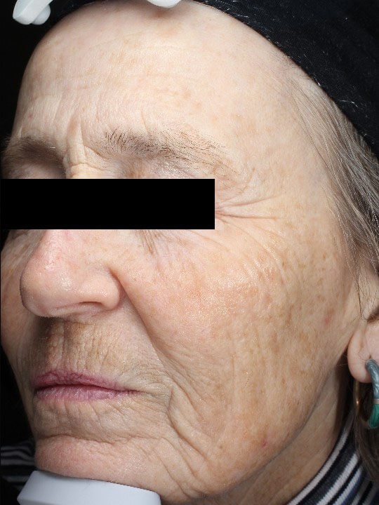 Chemical peel medium depth After (Oblique View)