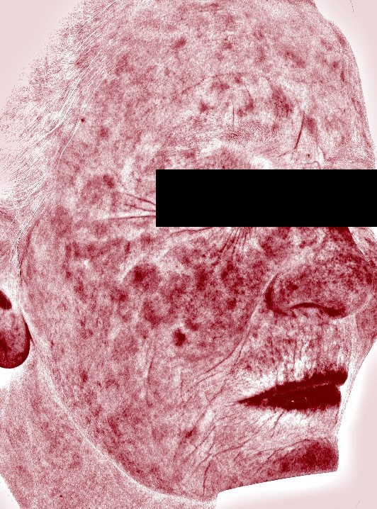 Chemical peel medium depth Before (Side View)