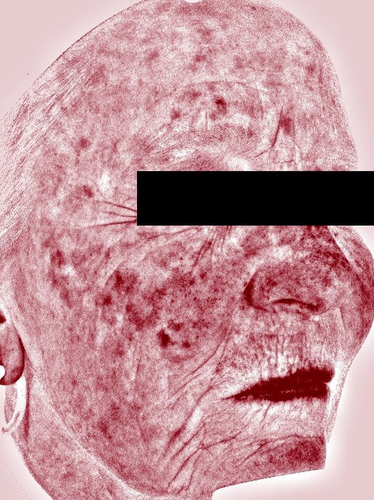 Chemical peel medium depth After (Side View)