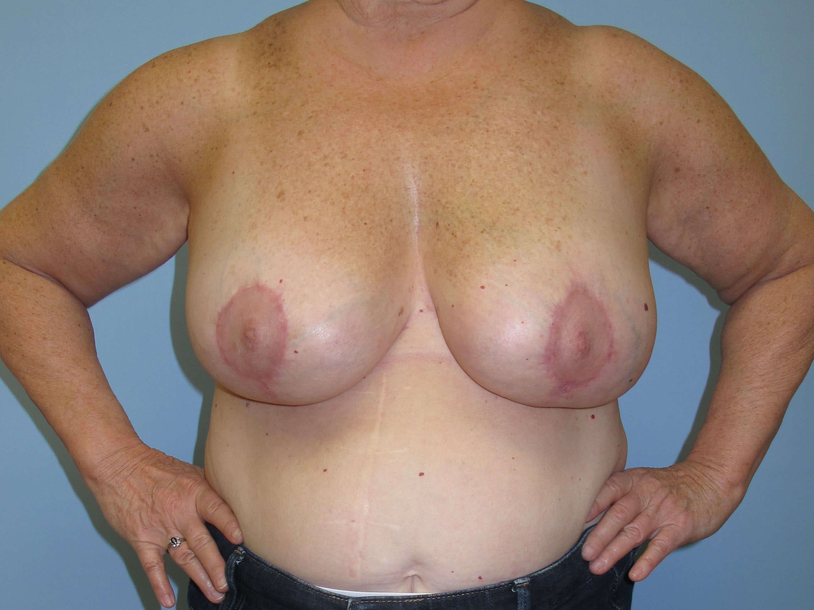 Breast Reduction After (Front)